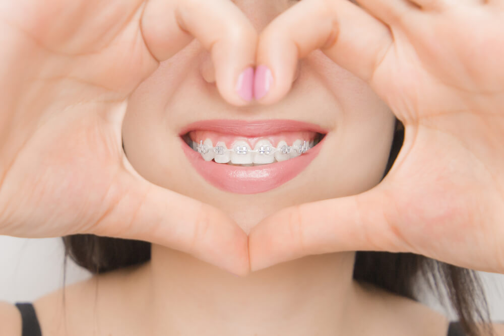 Les gouttières d'alignement , un traitement orthodontique revolutionnaire