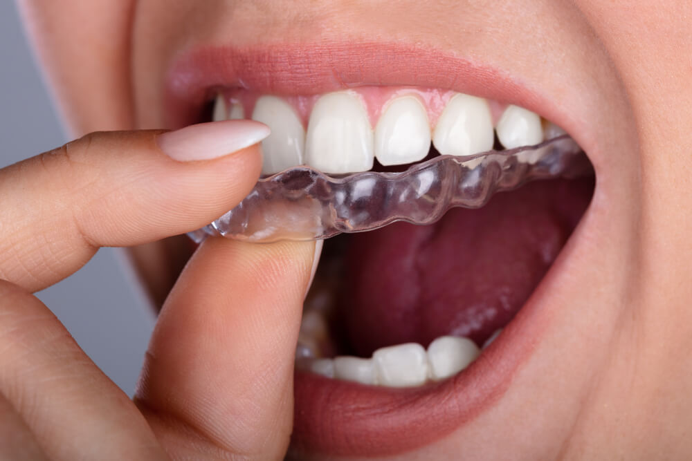 Grincement des dents ou bruxisme : comment le traiter ? - Centre Medico  Dentaire à Luxembourg