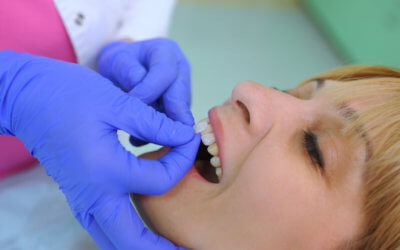 Tout savoir sur les facettes dentaires